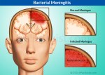 Bacterial-Meningitis